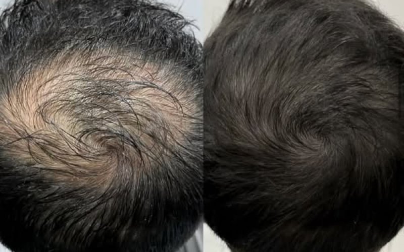 Saç Çoğaltma Nedir, Nasıl Yapılır? – Ameliyatsız Saç Çoğaltma